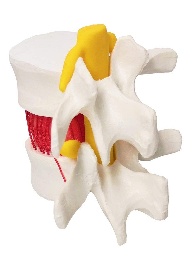 EVOTECH SCIENTIFIC Human Herniated Disc Model, Anatomical Herniated Lumbar Vertebrae Disc Prolapse Model for Medical Teaching Learning, Education Display Tooling, Student Learning Education Display Tool 3 Pack - Image 4